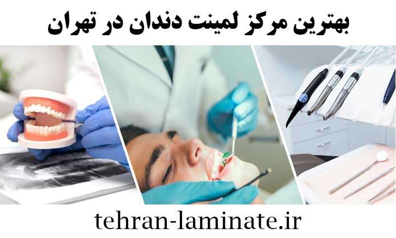 لمینت دندان