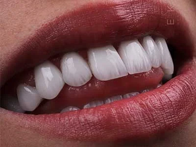 سرامیک یا روکش