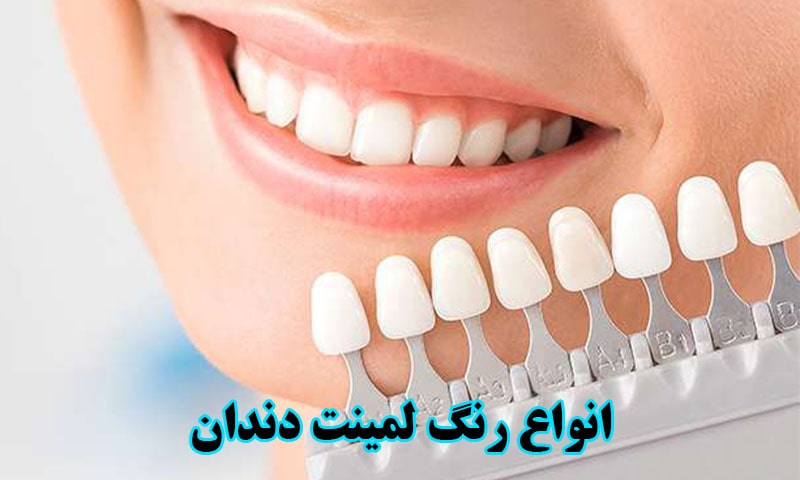 انواع لمینت دندان