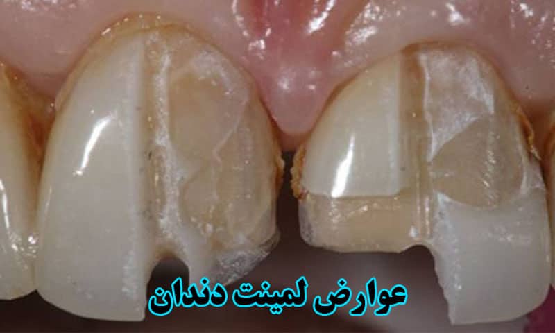 عوارض بعد از لمینت دندان