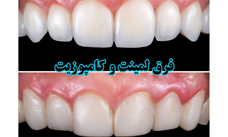 فرق لمینت و کامپوزیت