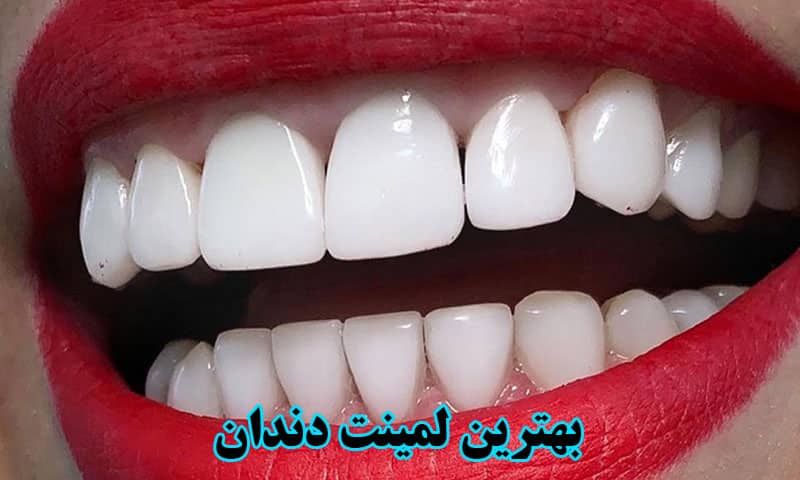 بهترین لمینت دندان