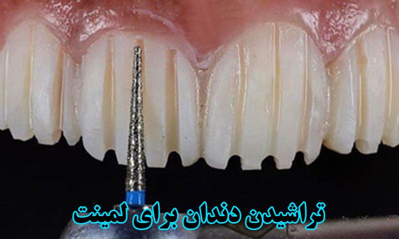 تراشیدن دندان برای لمینت