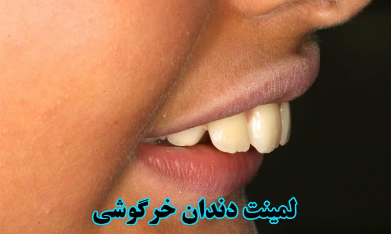 لمینت دندان خرگوشی