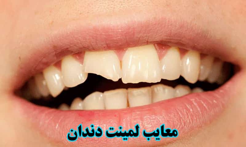 معایب لمینت دندان