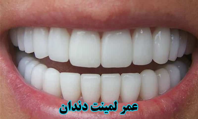 عمر لمینت دندان
