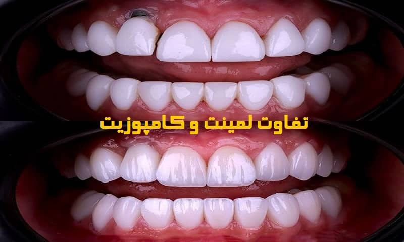 تفاوت قیمت لمینت و کامپوزیت