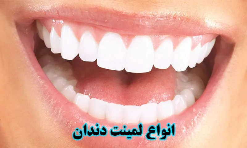 انواع لمینت دندان - بررسی معایب، مزایا و هزینه ها