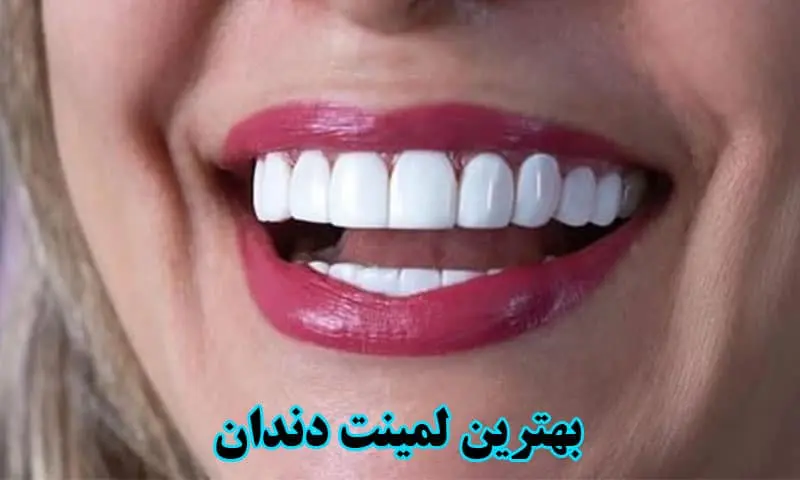 بهترین لمینت دندان - برترین برند کدام است؟