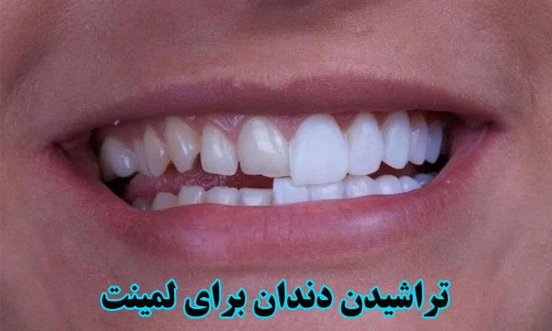 تراشیدن دندان برای لمینت - نحوه و میزان تراش به چه صورت است؟