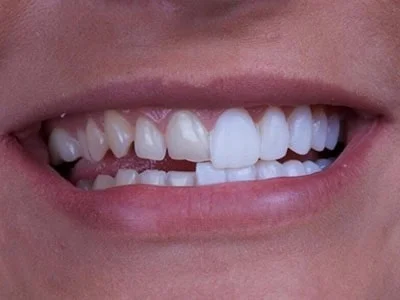 تراشیدن دندانها برای لمینیت