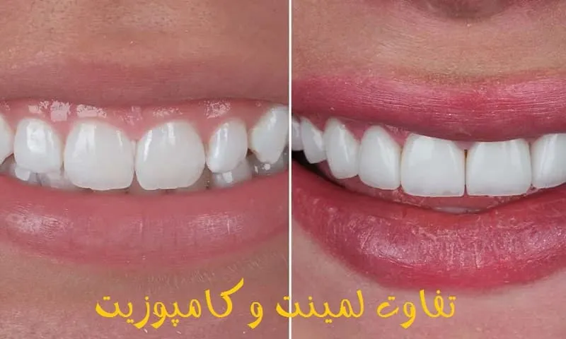 تفاوت لمینت و کامپوزیت - بررسی صفر تا صد تفاوت لمینت و کامپوزیت - بررسی صفر تا صد