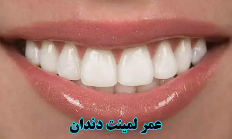 عمر لمینت دندان - ارائه راهکارهای افزایش ماندگاری