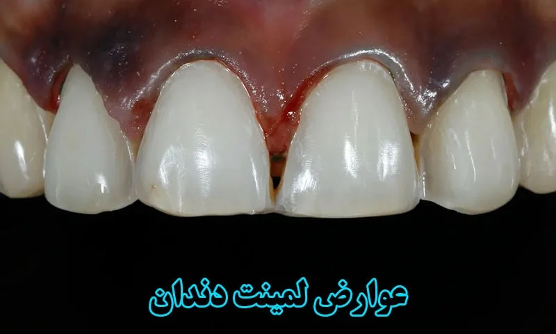 عوارض لمینت دندان - راه حل های مقابله با آن