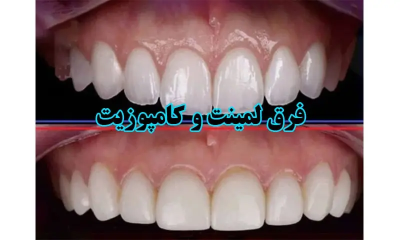 فرق لمینت و کامپوزیت - بررسی تفاوت ها، مزایا و معایب