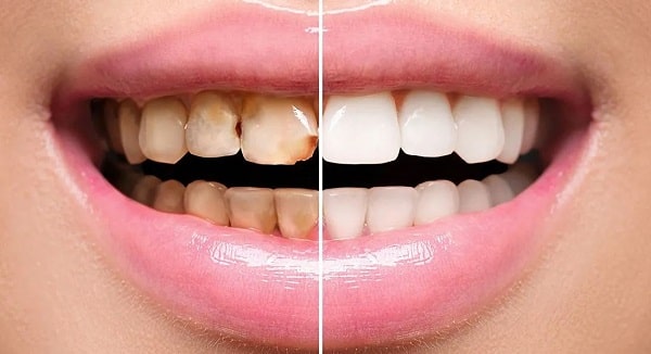 قیمت لمینت دندان به چه عواملی بستگی دارد؟