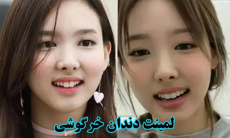 لمینت دندان خرگوشی - کاربردها، مزایا و قیمت