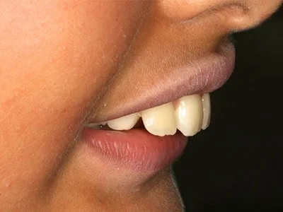 لمینیت دندانهای خرگوشی