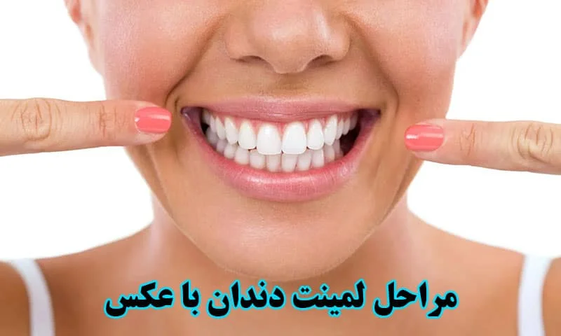 مراحل لمینت دندان - توضیح هر مرحله همراه با عکس