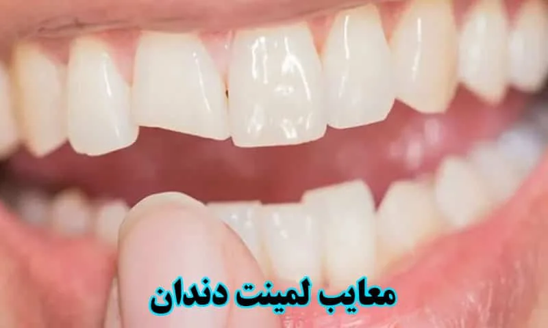 معایب لمینت دندان - بررسی نارضایتی ها و پشیمانی ها